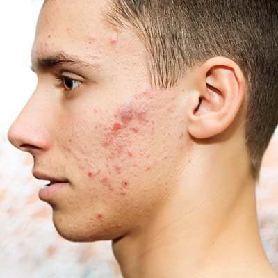 Acne Treatment