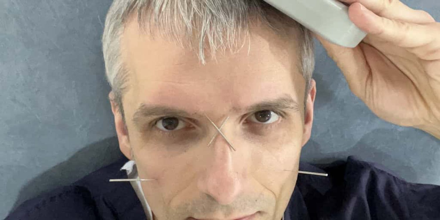 Benefits of Transcranial Magnetic Stimulation